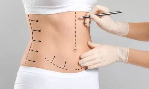 lipoaspiration